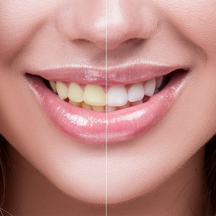 Vergleich Vorher-Nachher Bleaching Vergleich Vorher-Nachher Bleaching